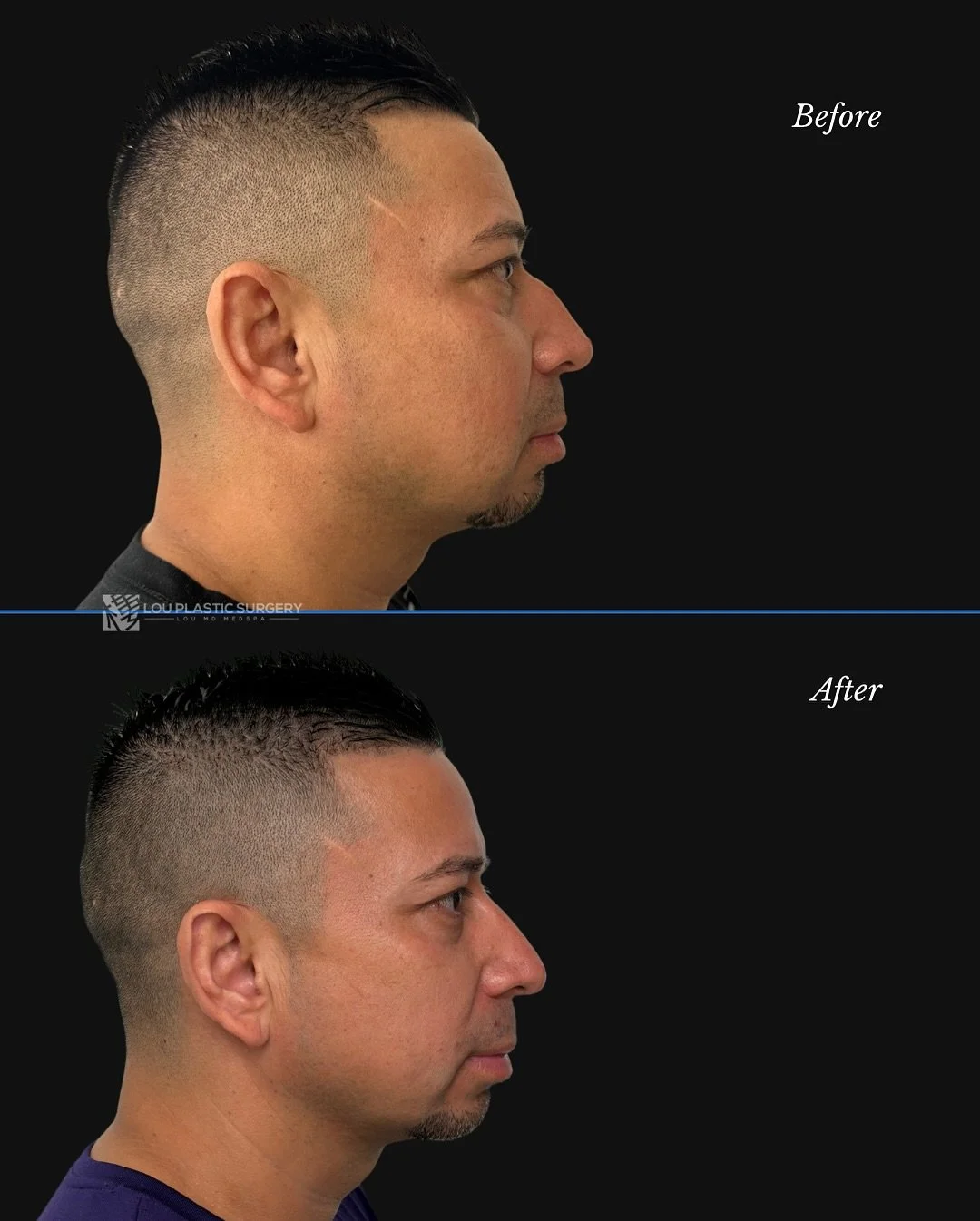 Our rhinoplasty patient is now 8 months post-surgery 👃🏼✨ As a male, he wanted to keep the natural character of his nose while reducing the large dorsal hump that stood out in his side profile. 🔍

We focused on maintaining results that look natural