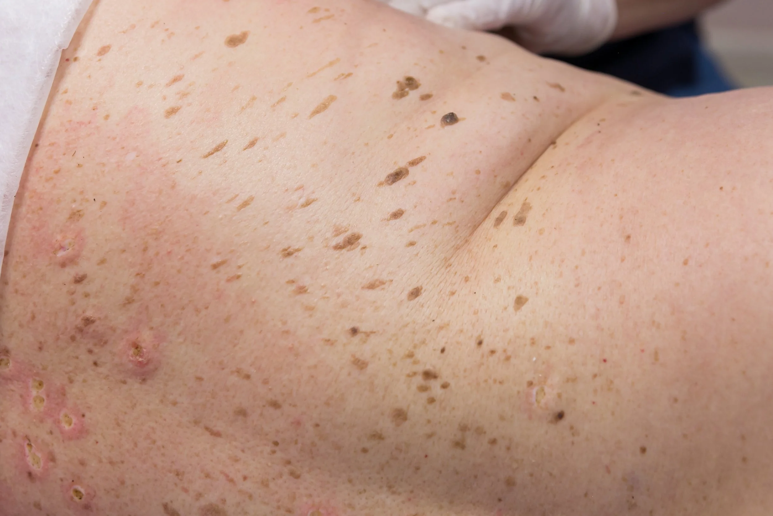 seborreiske keratoser