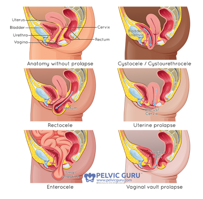 “Permission to use copyright image from Pelvic Guru, LLC pelvicguru.com”