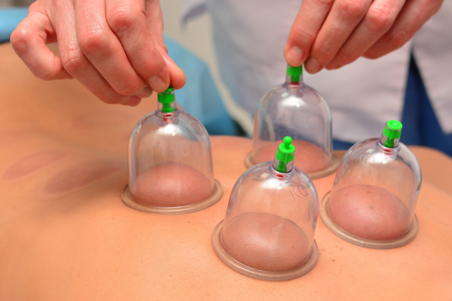 a massage therapy performing cupping therapy at Le Rêve Salon and Spa in Granada hills