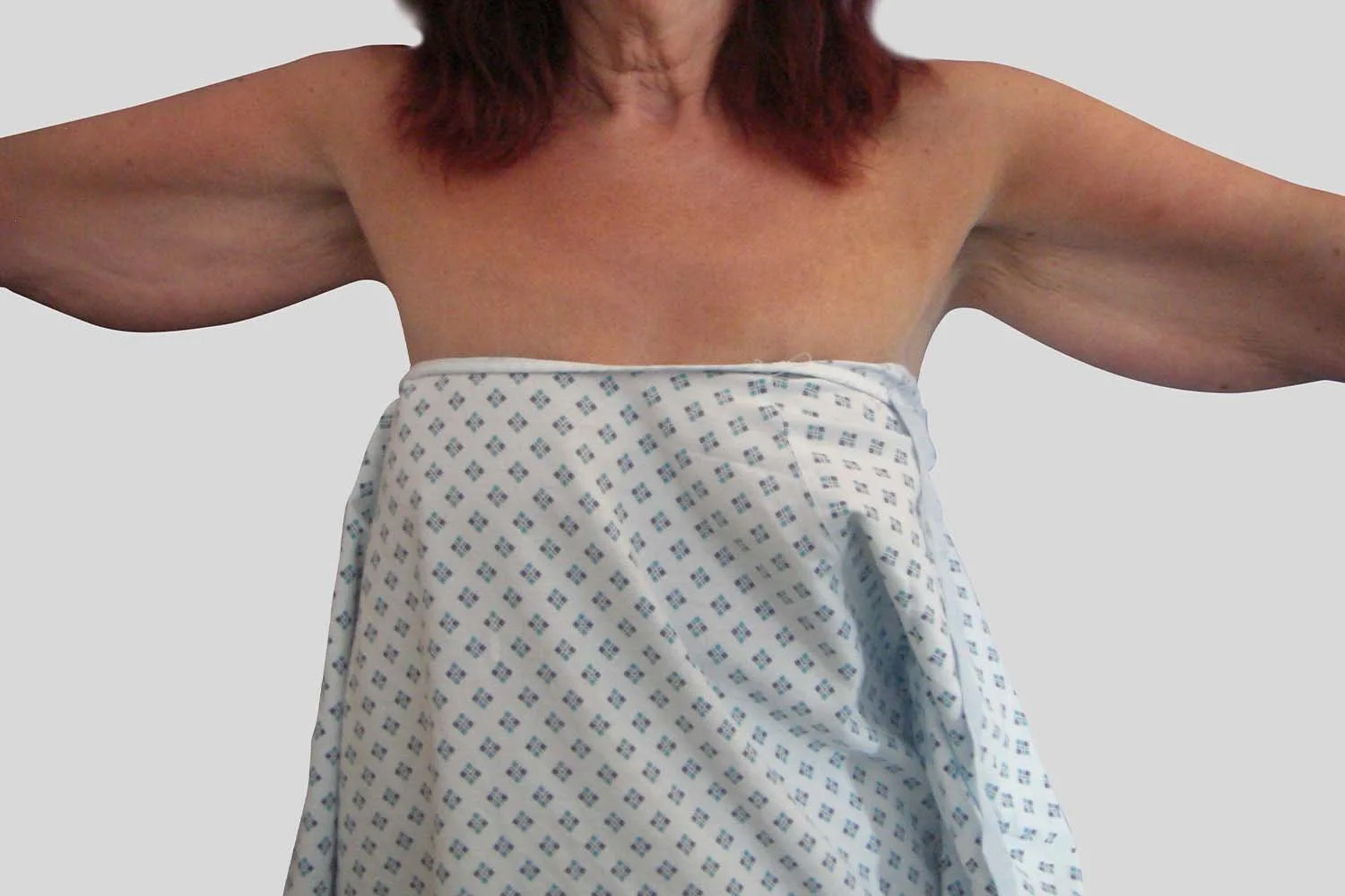 Before & After Arm Reduction Photos Restore Surgery — Restore Surgery