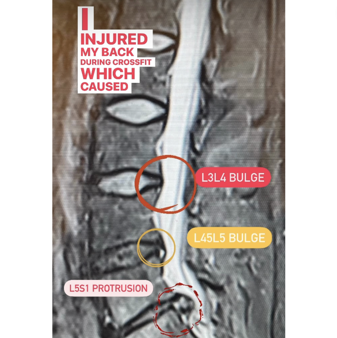 Crossfit Athlete Overcomes Pain from L3L4, L4L5 Disc Bulge, L5S1 Disc ...