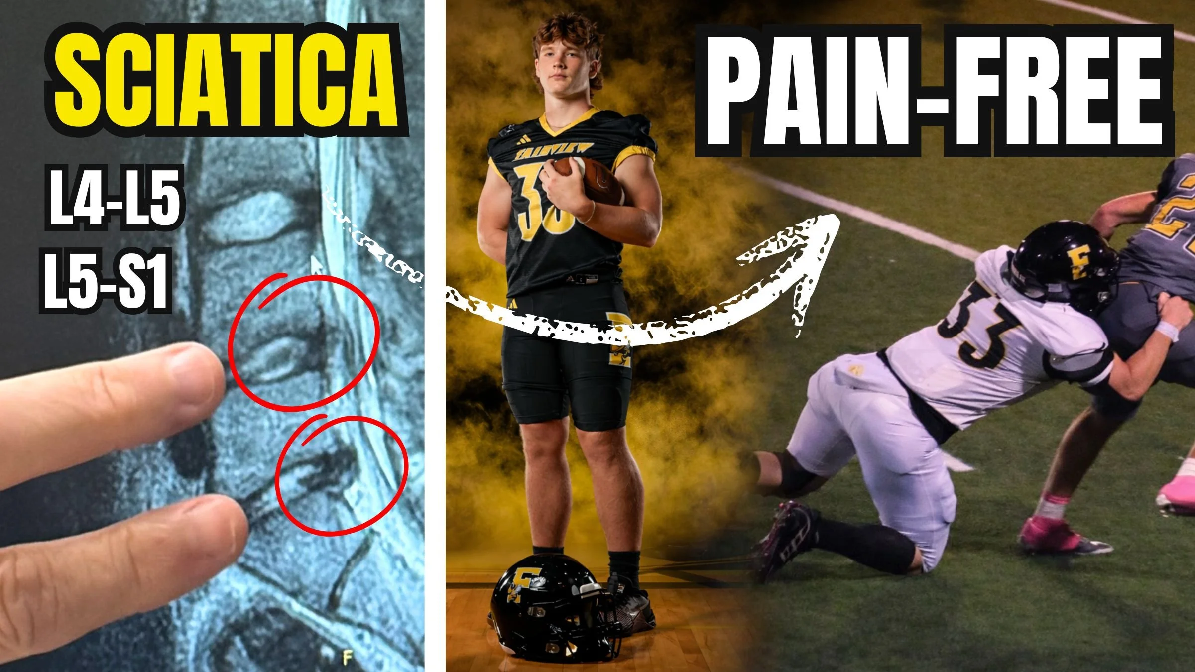 17-Year-Old Overcomes Spinal Stenosis, 2 Disc Herniations &amp; Sciatica to Become All-Region Football Linebacker (Doctors said “He’d Never Play Again”