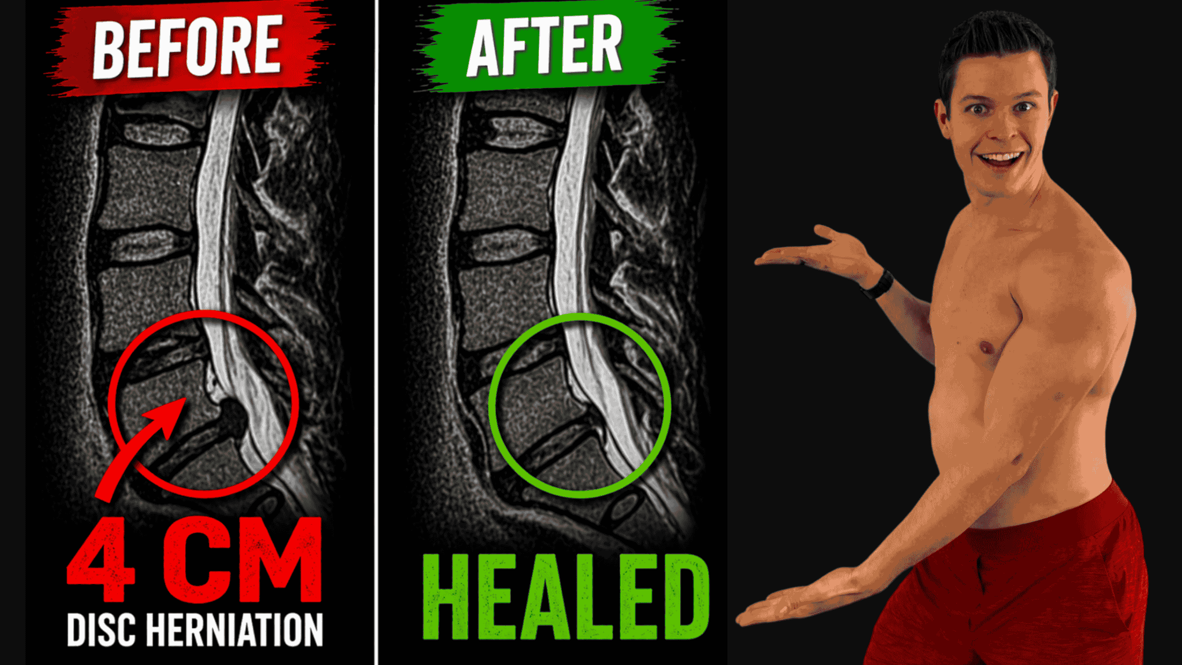 Doctor Said 99% Chance I'd Need Back Surgery for my ‘4cm Herniation’… Here’s How I Healed Without It
