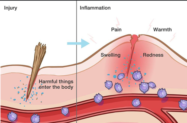 illustration showing inflammation