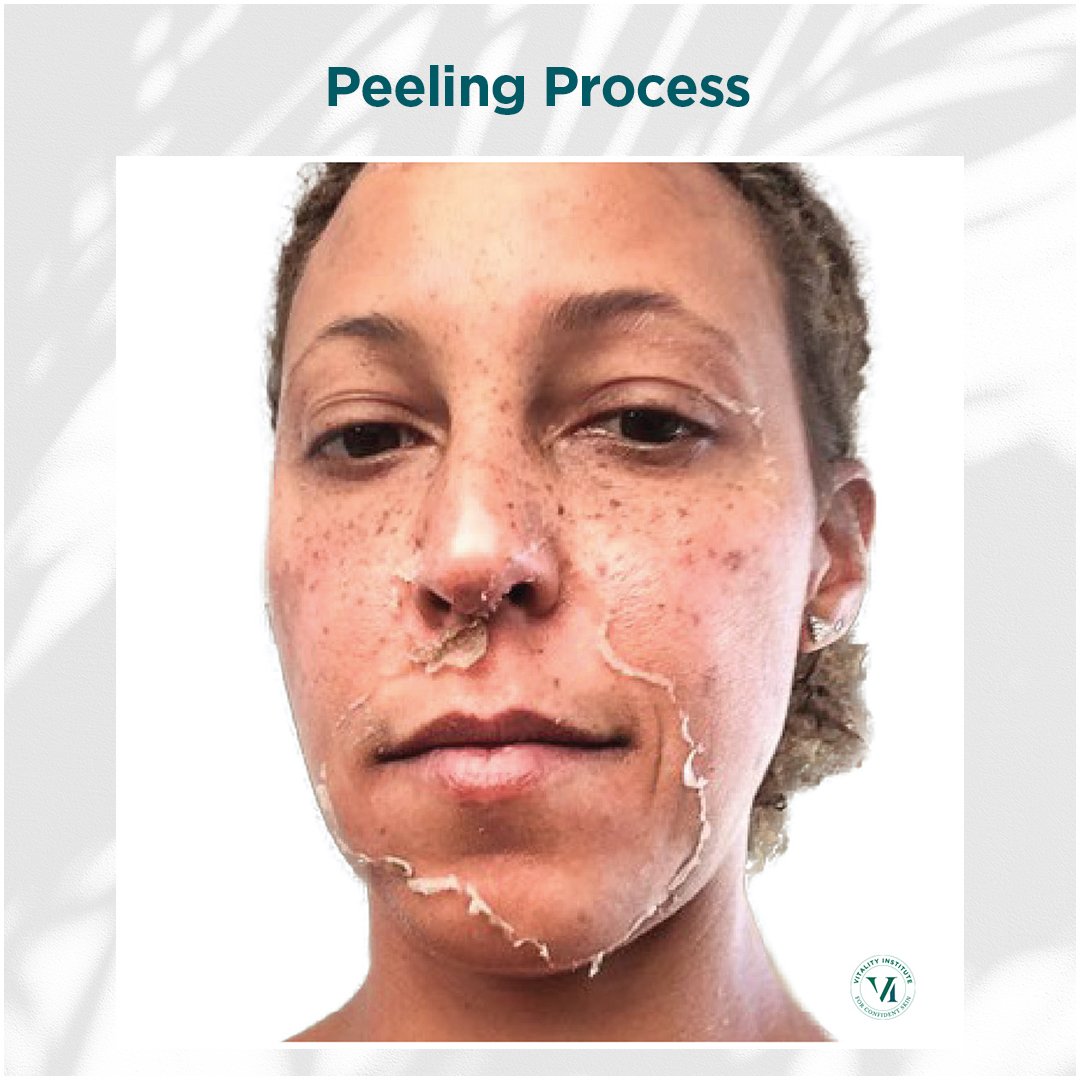Peeling_02.jpg