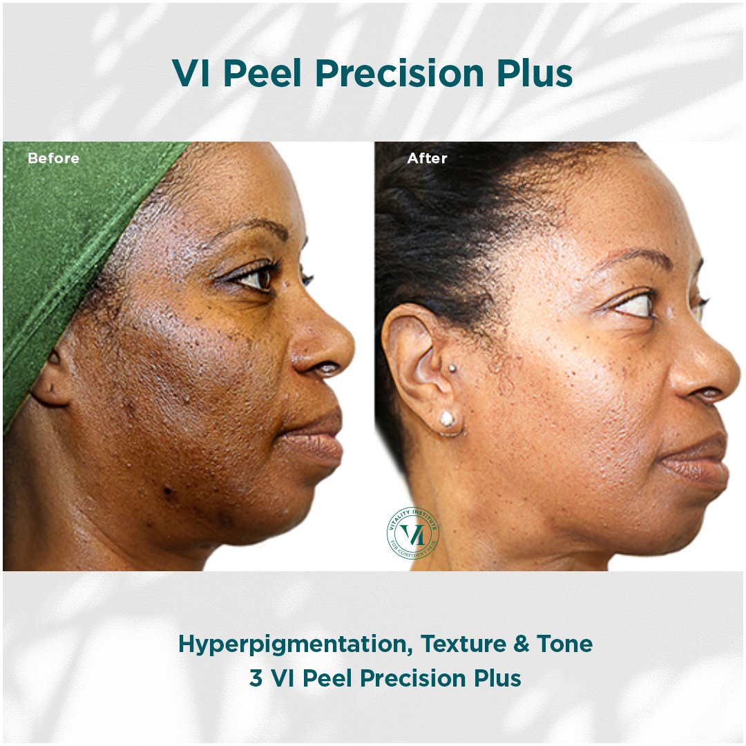 Hyperpigmentation, Texture & Tone.jpg
