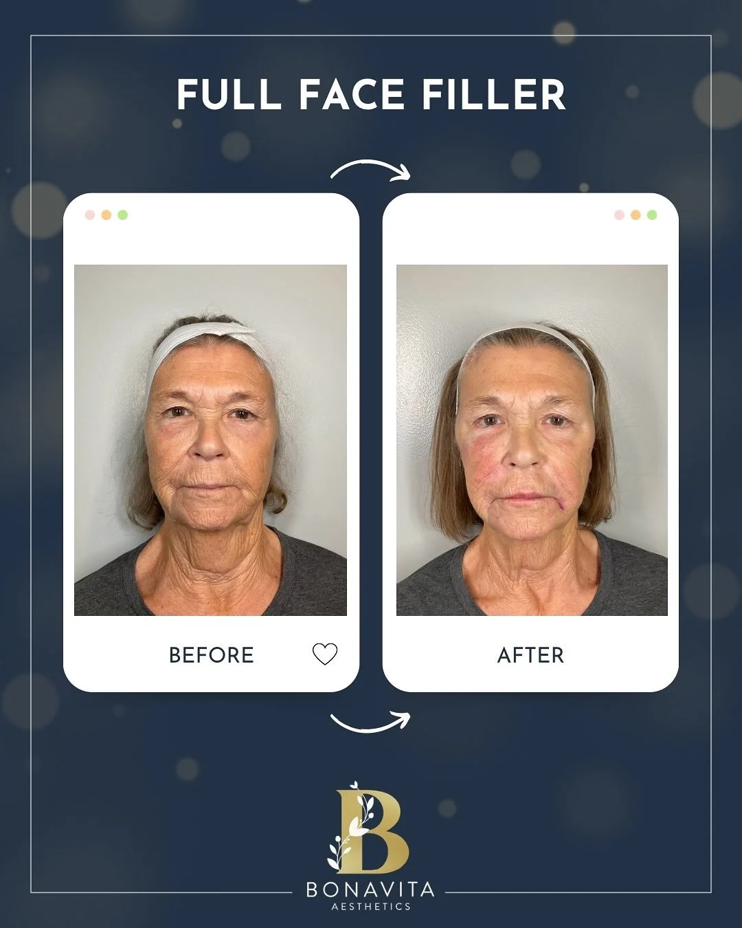 ✨💉 Experience a beautifully balanced, natural-looking enhancement with our Restylane portfolio of dermal fillers. 

Our expert techniques restore volume, refine shape, and create harmony across your features for a refreshed and youthful look.

📸 Af