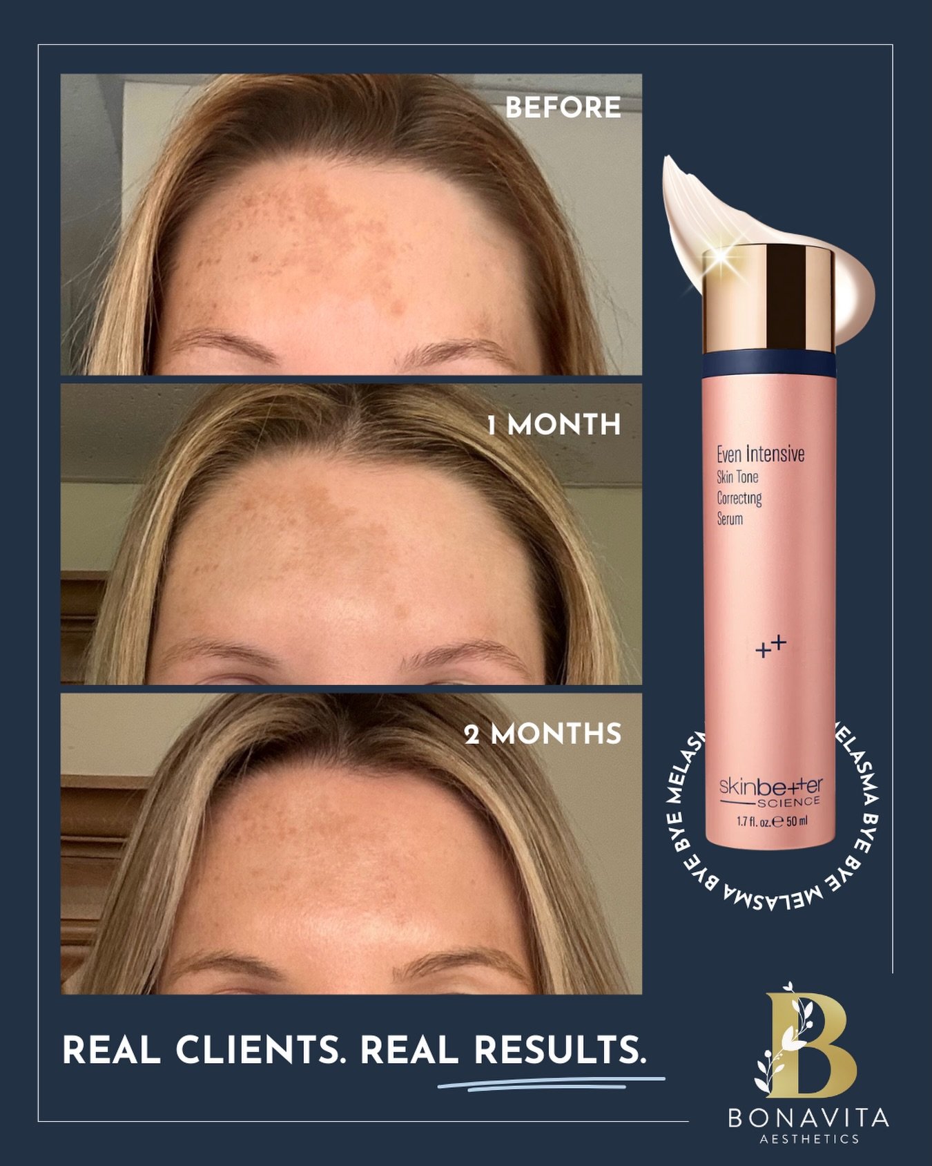 Melasma isn&rsquo;t a quick fix &mdash; it&rsquo;s long game management 🤎

Our #bonavitabeauty &rsquo;s  melasma flared aggressively during her second pregnancy, and since then we&rsquo;ve been working strategically with homecare to calm, correct, a