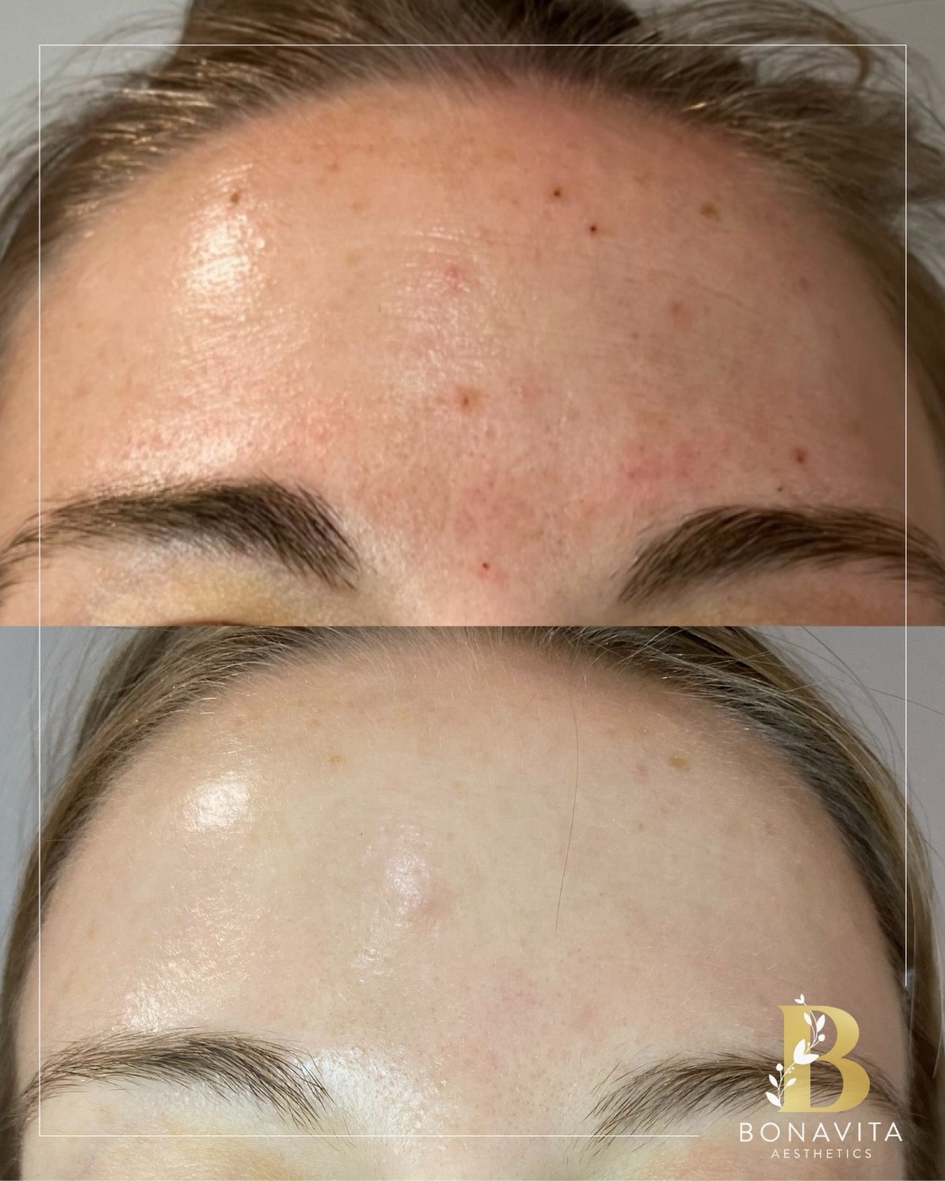 Wedding-ready skin takes more than a countdown 💍✨

When this bride-to-be came to us, her goal was simple: feel confident, calm, and radiant walking down the aisle.
 Through acne-focused skincare + corrective treatments, paired strategically with Bot