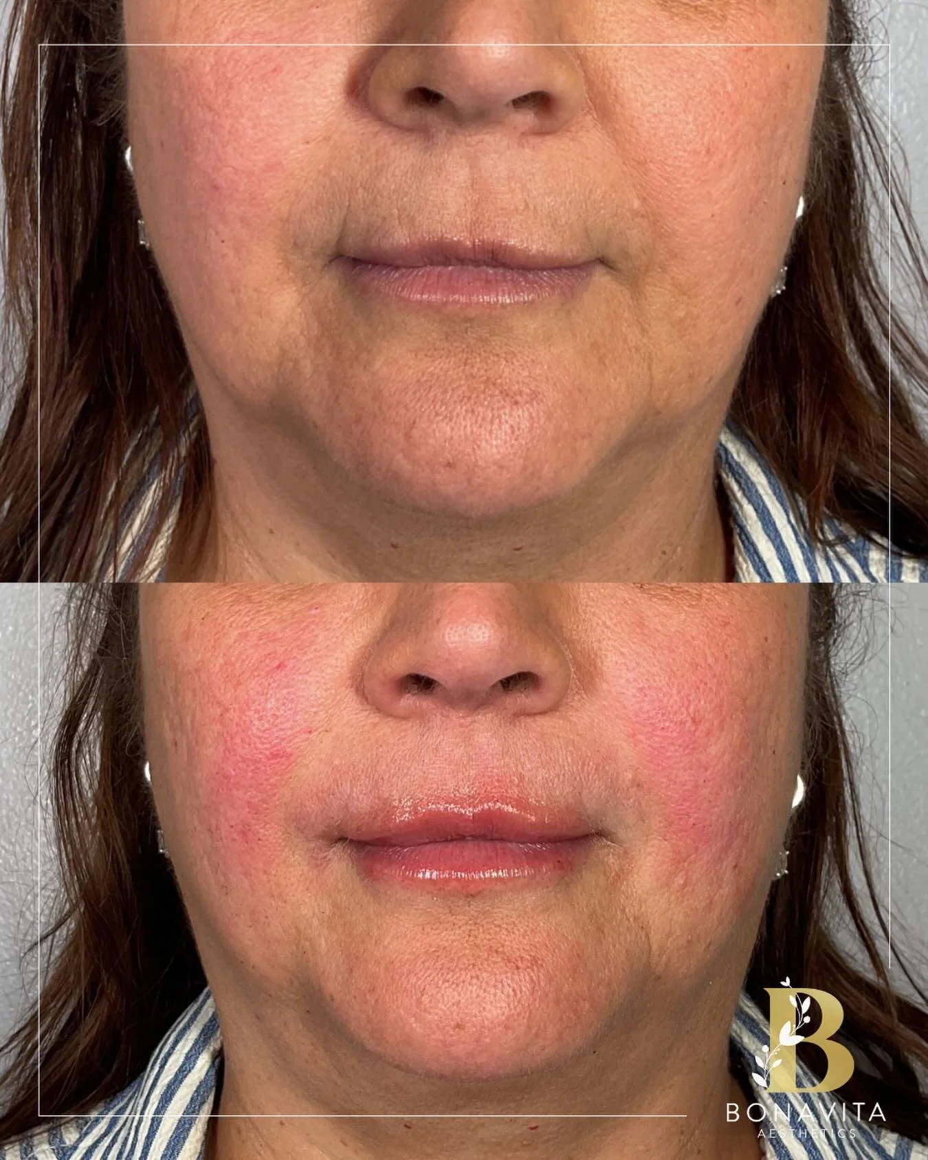 If you&rsquo;ve been scared of lip filler&hellip; this is your sign 👀

Refyne is perfect for:
💉 soft, flexible movement
💉 smoothing lip lines
💉 subtle volume + hydration

No stiffness. No overfilling. Just a refreshed, natural look 🤩 

👉🏼Your 