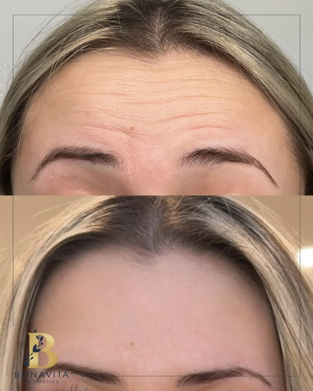 ✨ A first-time Dysport client&hellip; and she is already obsessed with her results by Nurse Nikki! 

At BonaVita Aesthetics, we customize every treatment based on your unique features, goals, and long-term plan&mdash;because your journey deserves mor