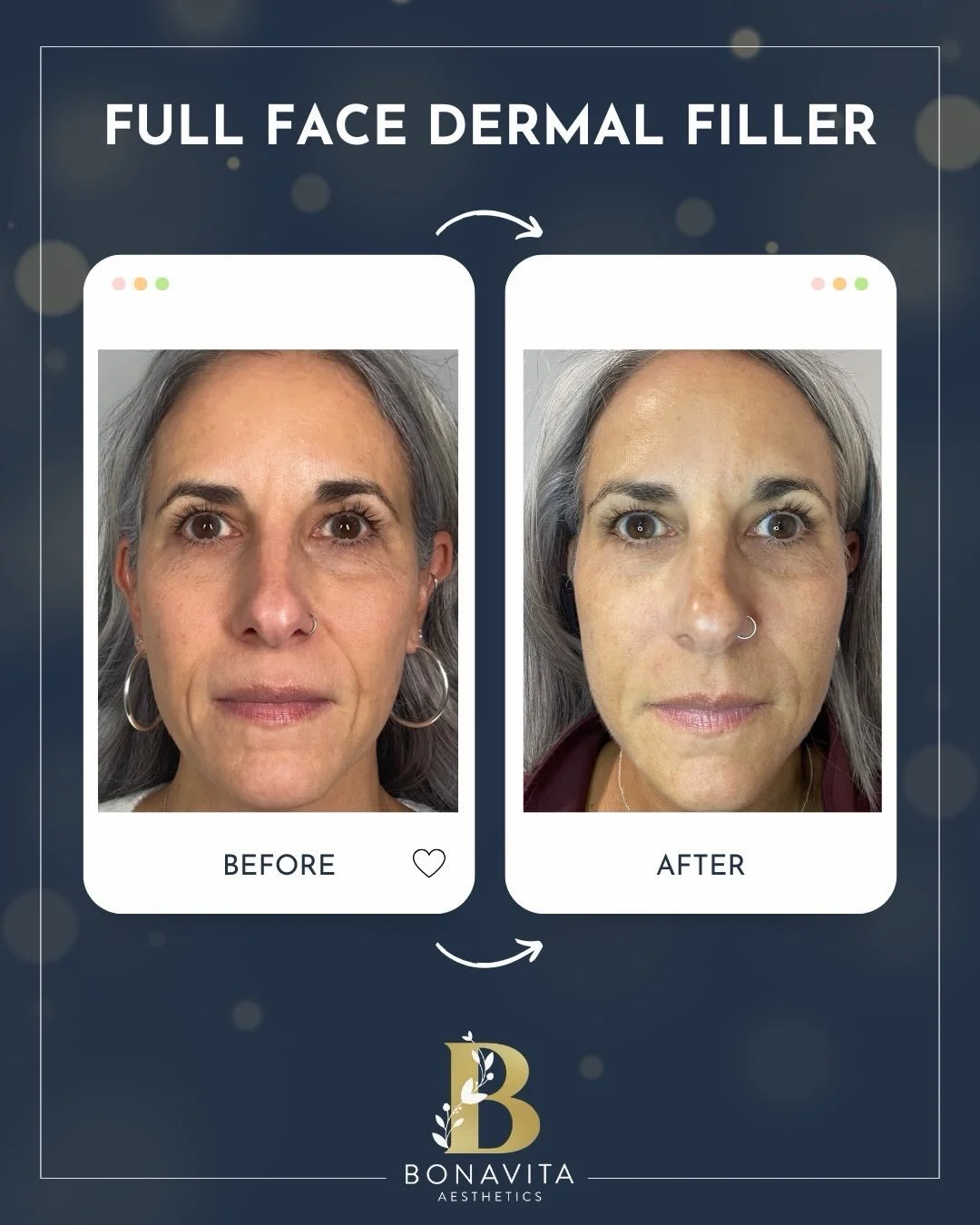 ✨ When filler is placed with intention, precision, and a deep understanding of facial anatomy, the results can be beautifully natural&mdash;not overdone!

At BonaVita, we focus on enhancing your features, restoring balance, and creating harmony throu