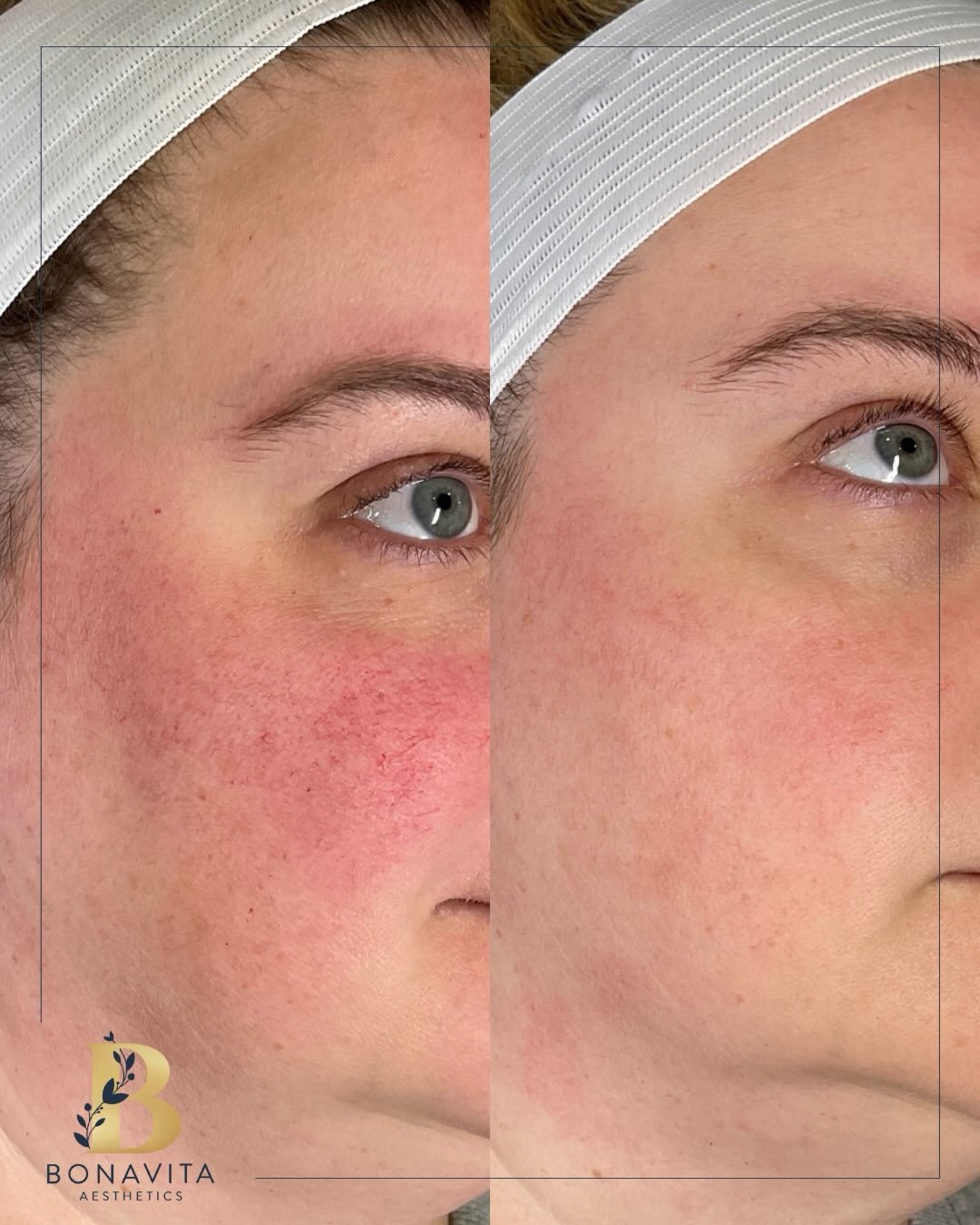 Before &rarr; After ✨

Real results, real consistency.

This client has completed 2 treatments using the Rohrer Spectrum Laser with a combination of IPL + Vein modalities to target pigmentation and vascular concerns&mdash;while supporting their skin 