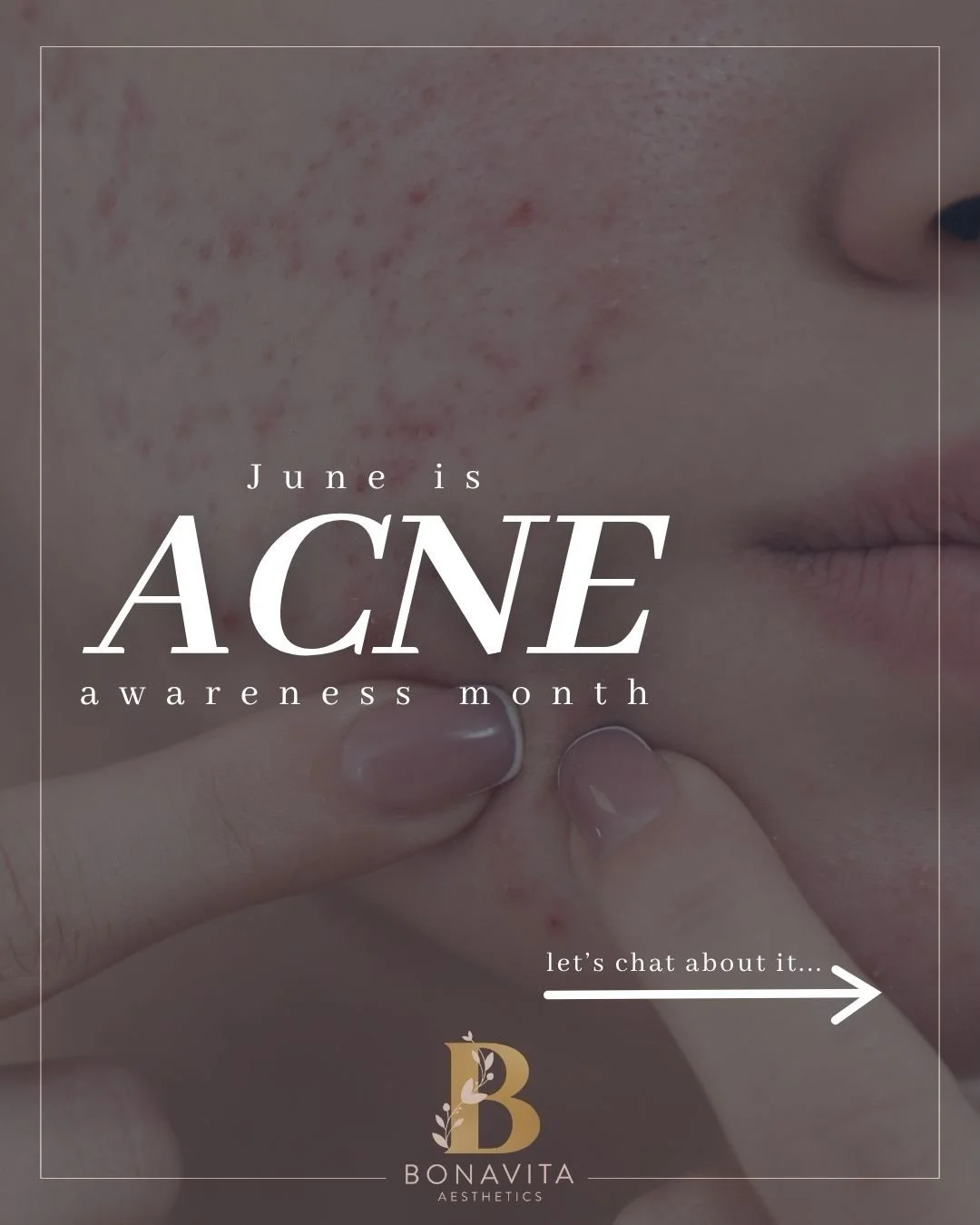 Acne is more than &ldquo;just a breakout.&rdquo; 

It can impact confidence, self-esteem, social situations, mental health, and the way someone feels showing up in their everyday life. And if you&rsquo;re currently struggling with acne, please know y
