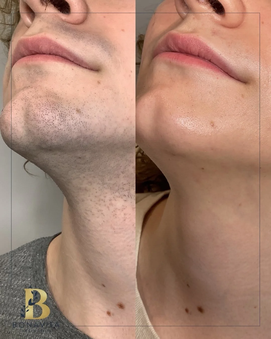 POV: You trusted the process for 18 months 

🪒 This lower face Laser Hair Reduction journey using @rohreraesthetics device didn&rsquo;t happen overnight, results come with consistency and commitment.

Thinking about starting? Book with our Nurses at