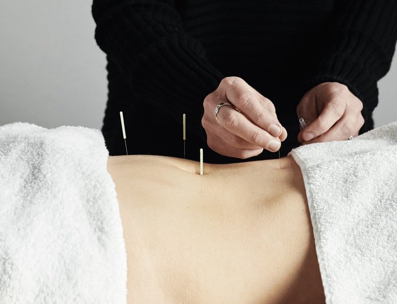 Acupuncture needles being inserted into the body to treat insomnia and sleep issues