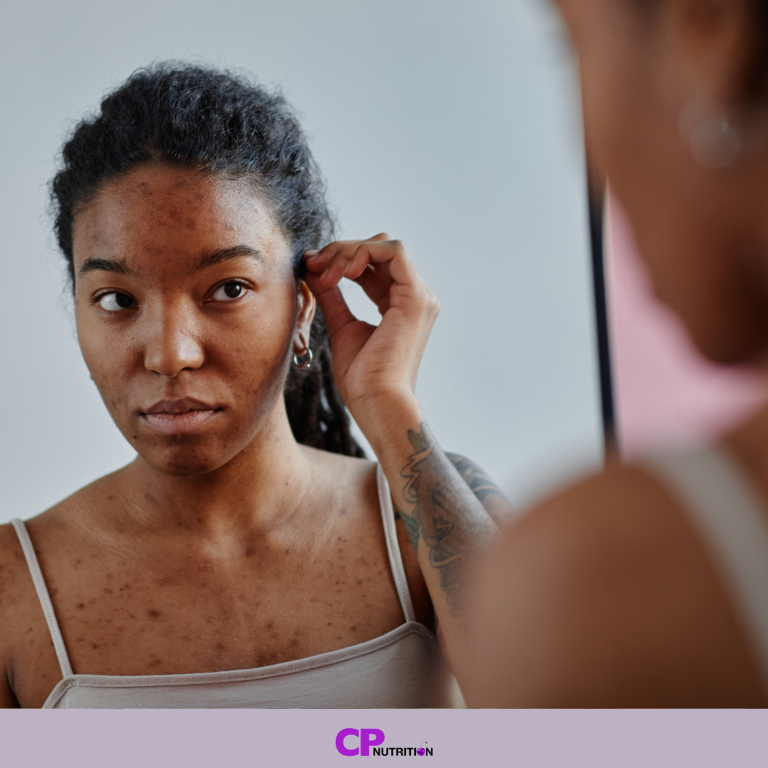 dairy foods may be linked with a higher likelihood of acne