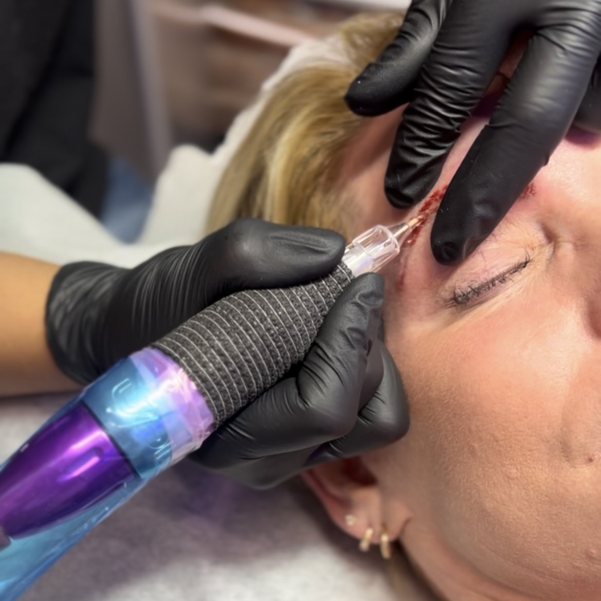 SALINE/STRETCH MARK REMOVAL