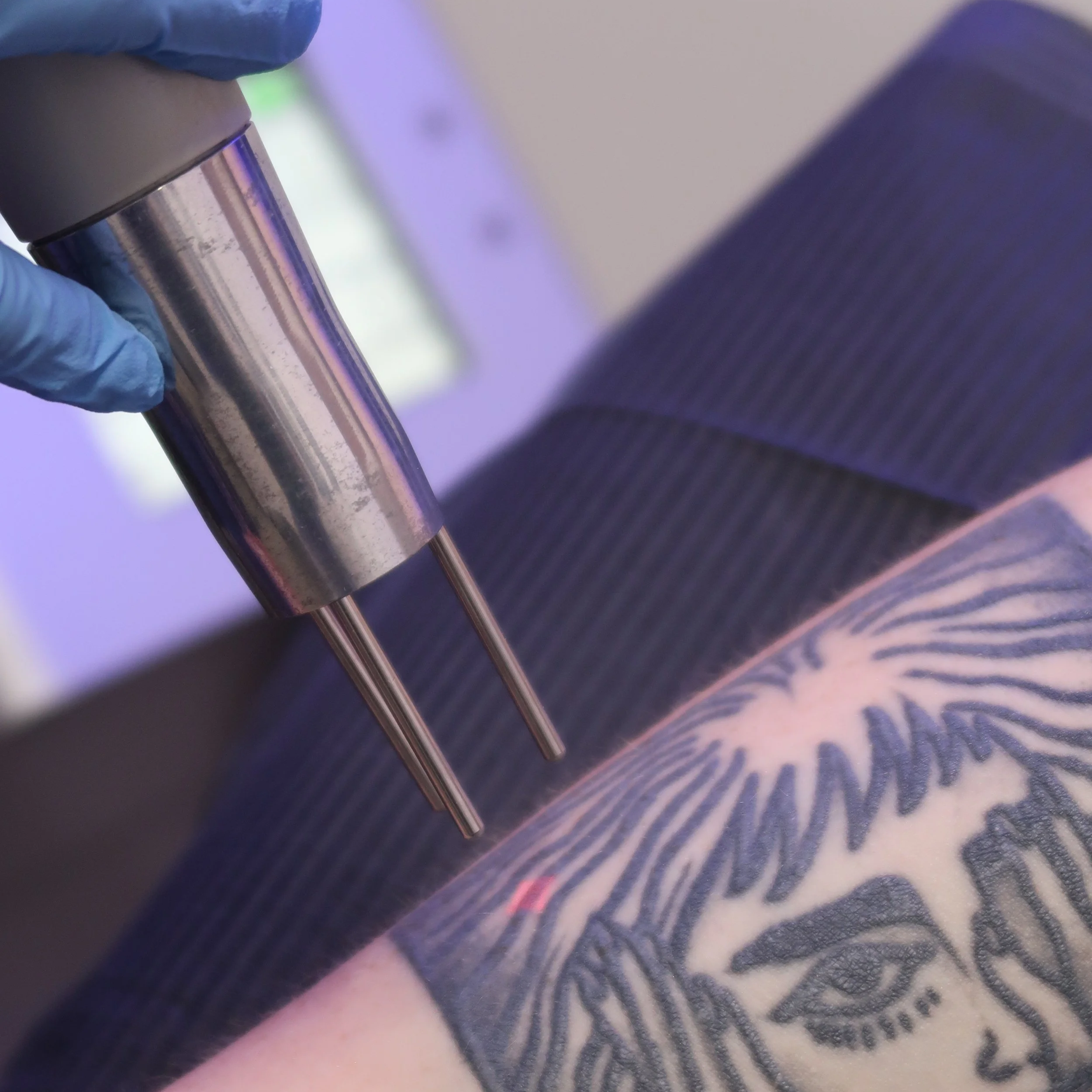 TATTOO REMOVAL