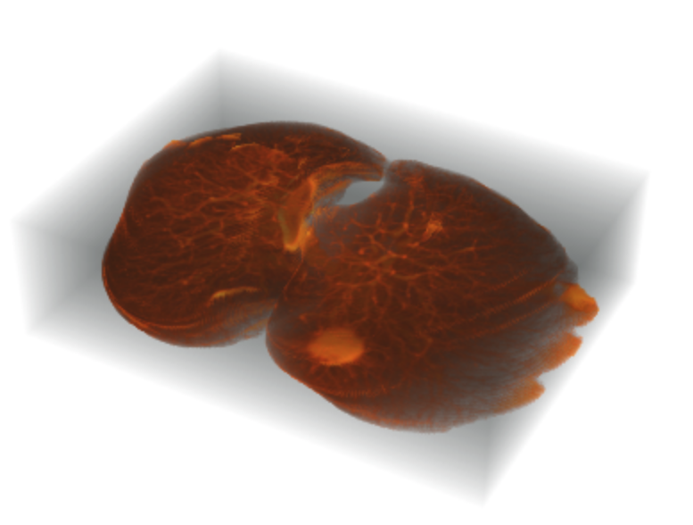 Detection of Lung Cancer Powered by Machine Learning (2017 - 2019)