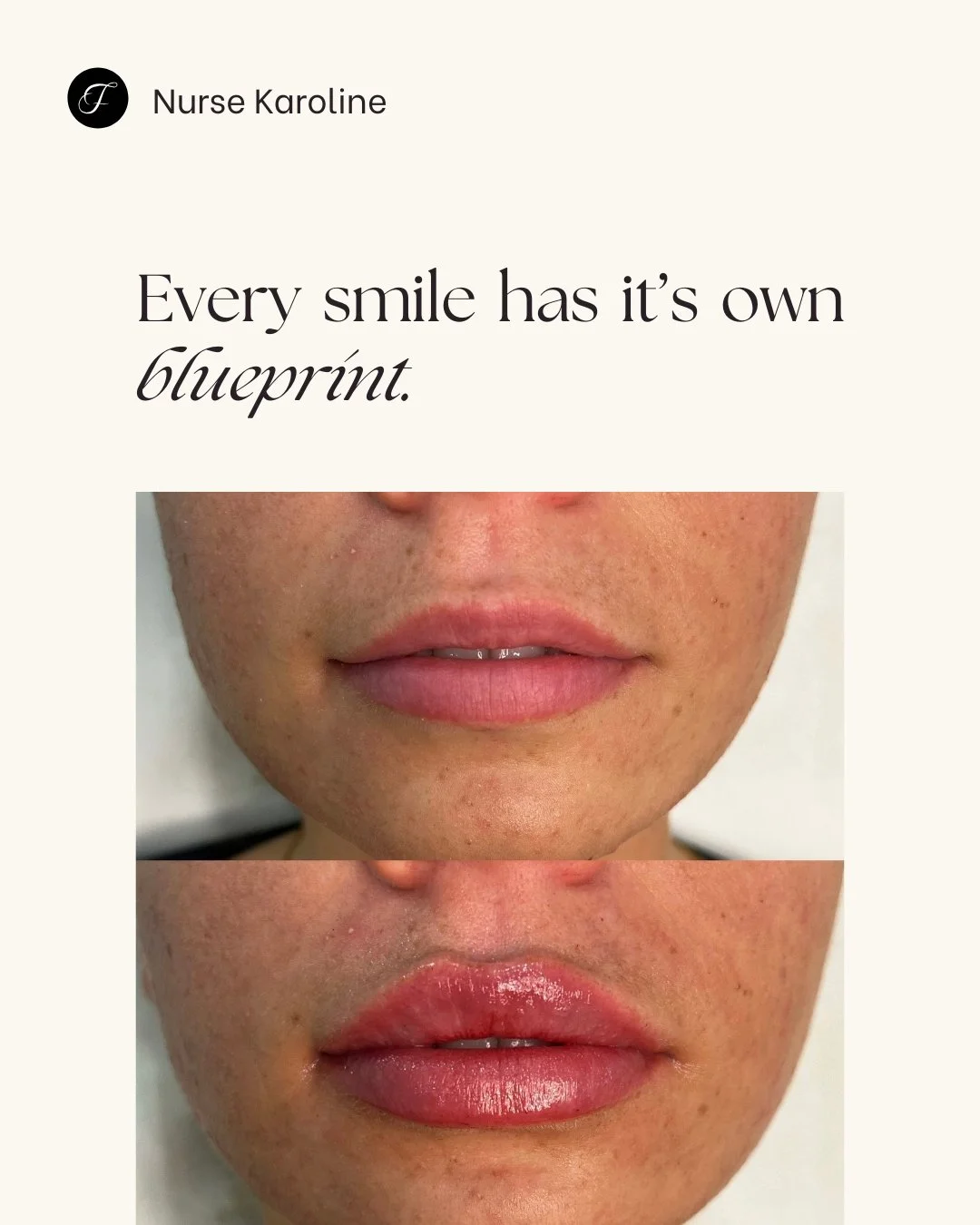 And that&rsquo;s exactly why no two lip treatments should look the same...

Lips aren&rsquo;t about trends, templates or making everyone look identical &mdash; they&rsquo;re about respecting your natural anatomy, movement and proportions. What you se