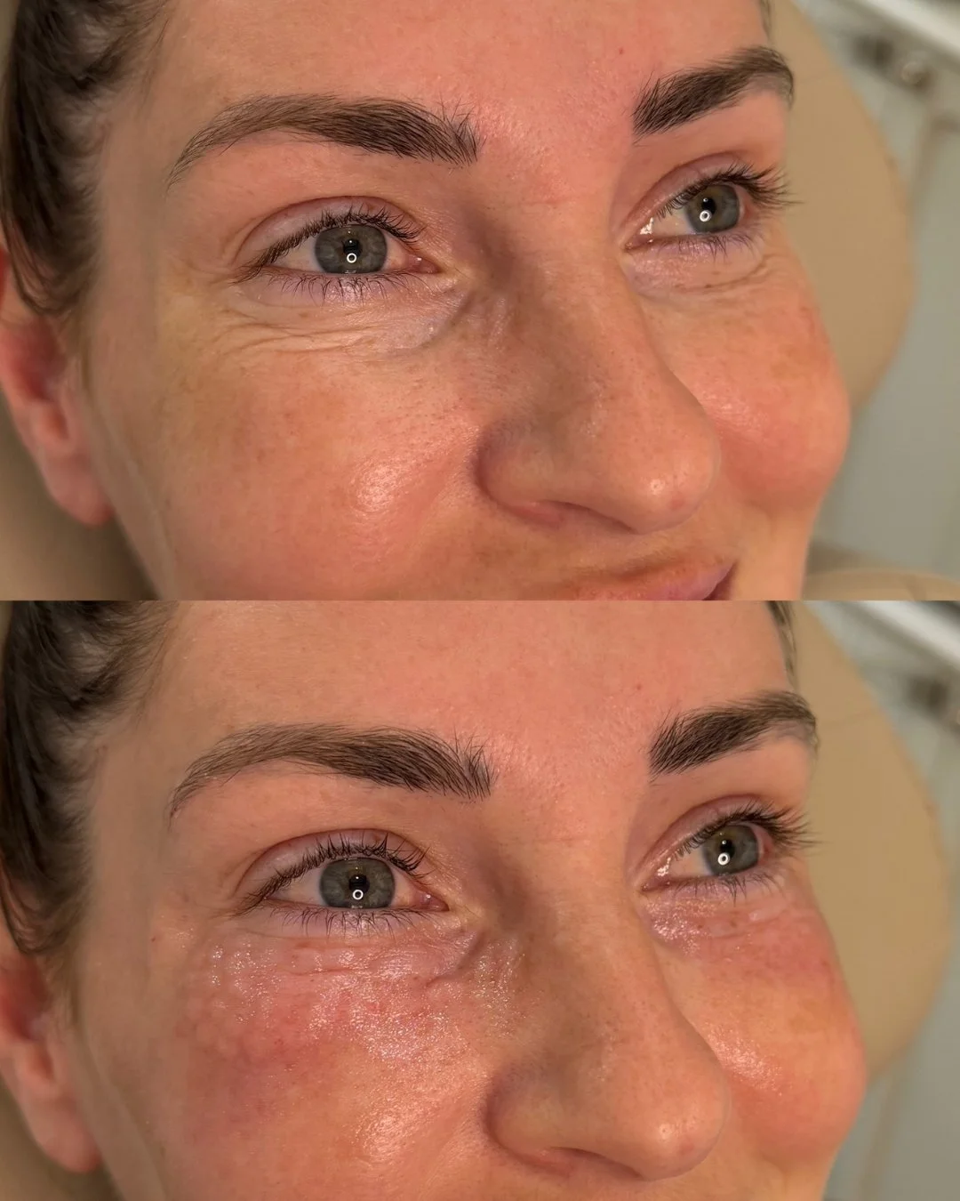 If I had a dollar for every &ldquo;Rejuran will fix your dark circles!! ✨✨&rdquo; post&hellip;
I could probably buy enough under-eye patches to last me a lifetime.

So let&rsquo;s clear the air.

Rejuran isn&rsquo;t magic.
It isn&rsquo;t a one-size-f