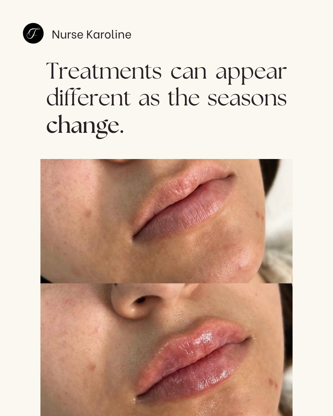 Muscle activity, hydration and circulation shift in cooler weather, which can make lines appear softer or more noticeable depending on the individual. This doesn&rsquo;t mean something has suddenly worn off &mdash; it often reflects changes in how th