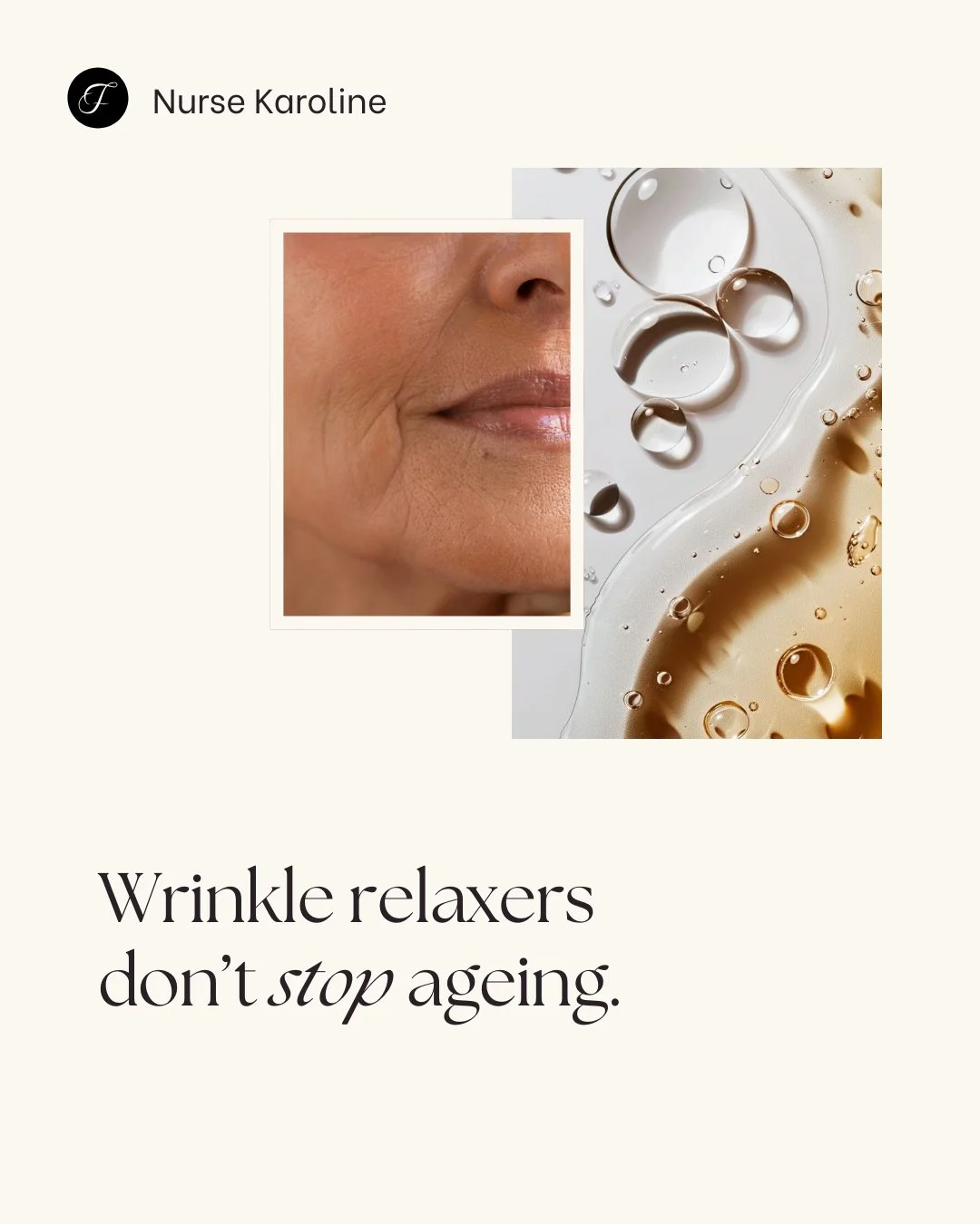 Wrinkle relaxers don&rsquo;t stop ageing.

They soften repetitive muscle movement so the skin isn&rsquo;t constantly folding in the same place. Ageing still occurs &mdash; the goal is simply to influence how strongly certain lines settle over time.

