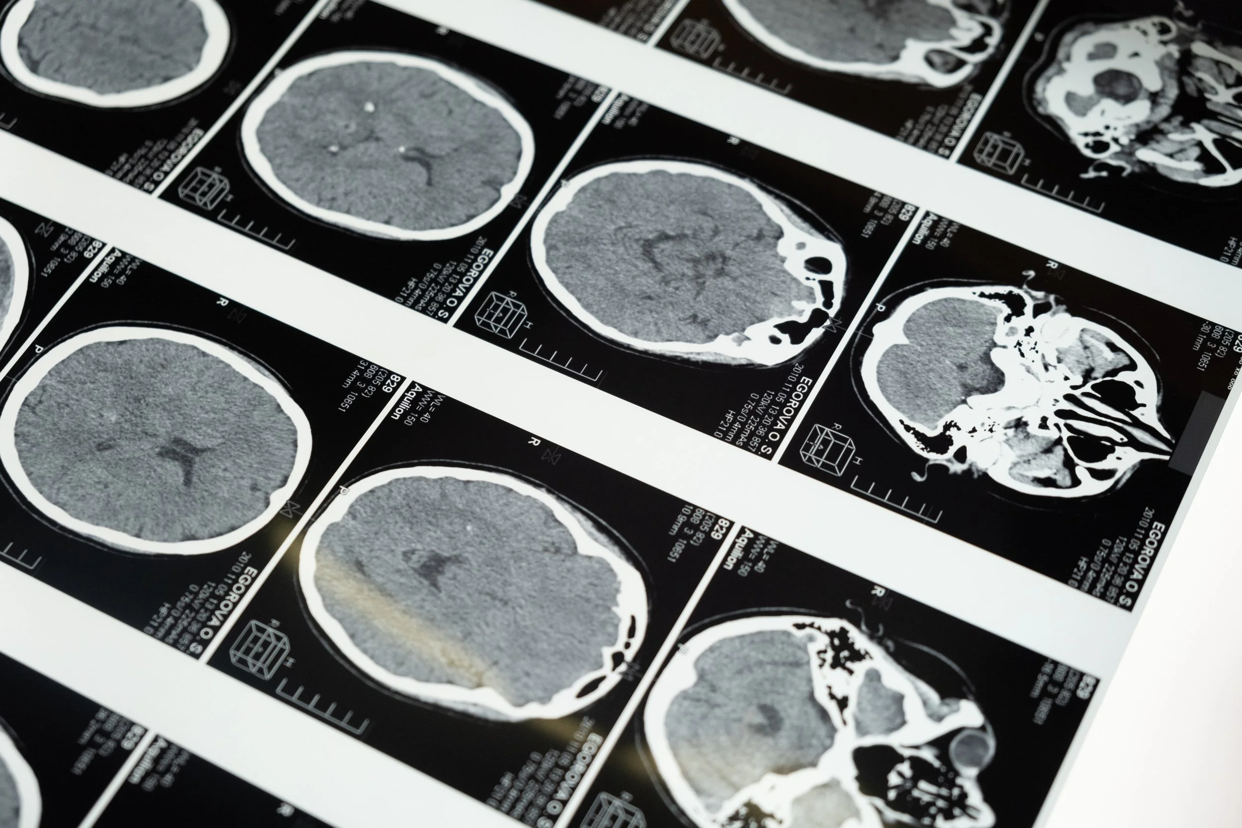 Fibromyalgia and the Brain