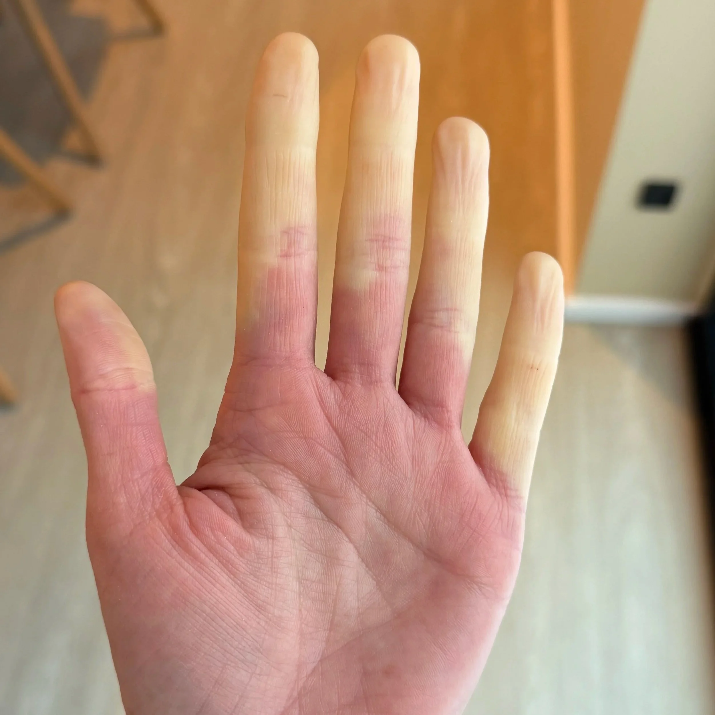 Raynauds Syndrom
