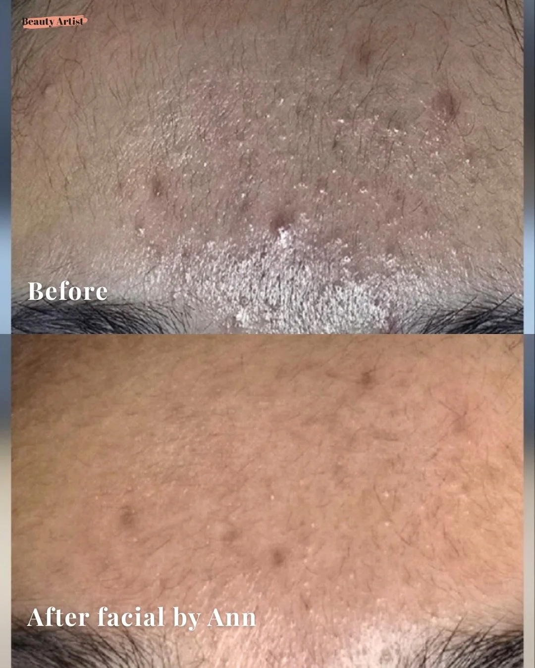 This is why facials matter ✨
Real skin. Real results. No filters. No editing.

Swipe to see the before &amp; after of a Korean-style facial by Ann (@ann.beautyartistny) &mdash;
improved texture, clearer pores, smoother skin, and a healthier glow righ