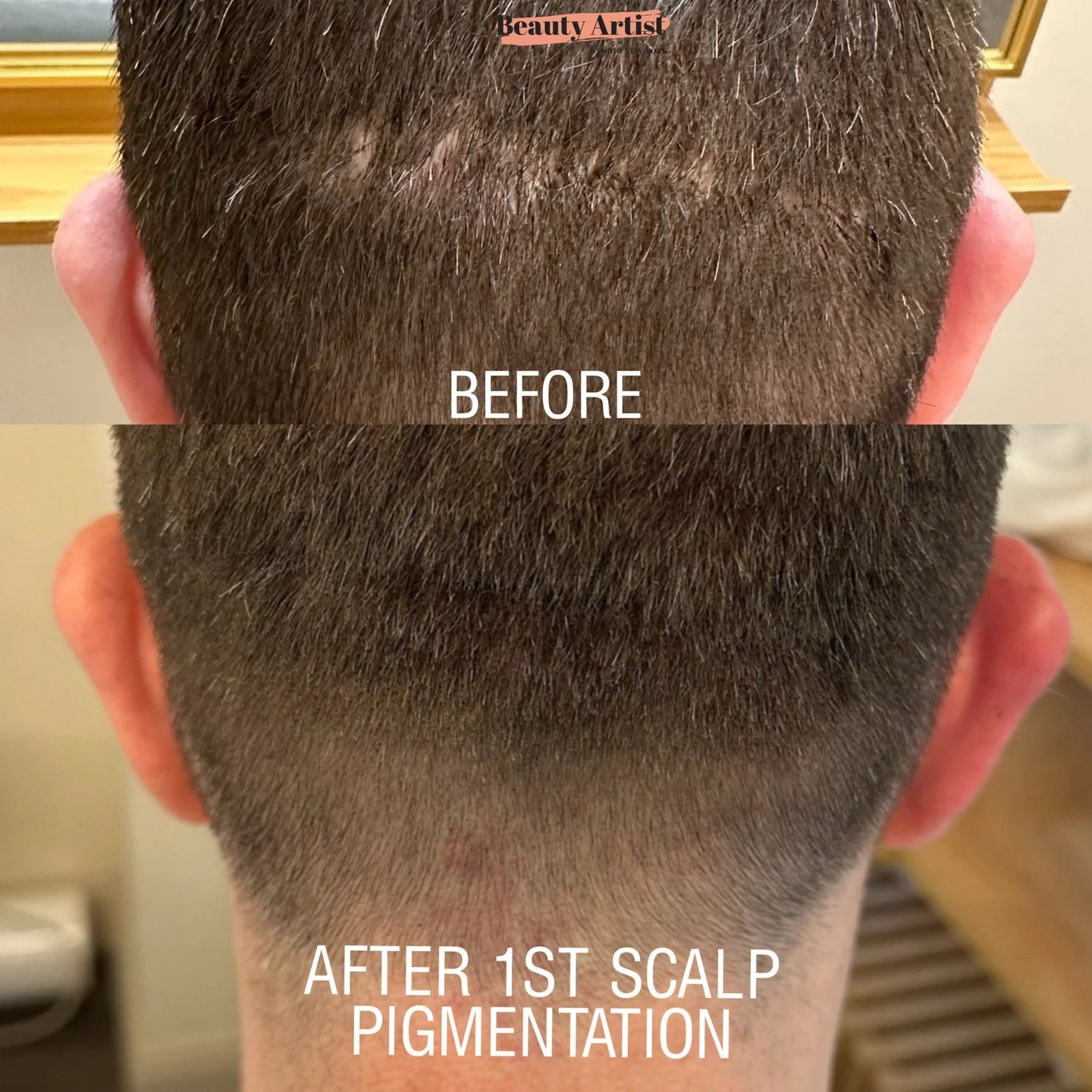 Scalp Micropigmentation (SMP) for Hair Transplant Scars ✨⁠
⁠
Designed to soften and camouflage visible scarring by seamlessly blending pigment into the scalp &mdash; creating the look of fuller, more even density.⁠
⁠
✔ Reduces contrast between scar t