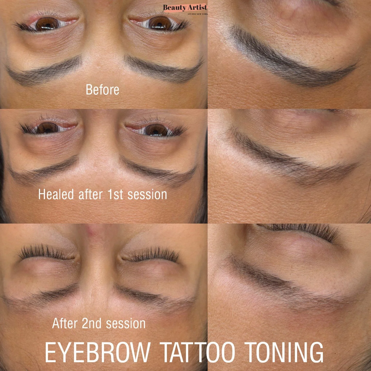 Old eyebrow tattoo turning ashy,reddish or uneven over time? 😰

Over time, eyebrow tattoo pigments can change depending on many factors such as:
▫️ Skin type &amp; condition
▫️ Sun exposure
▫️ Lifestyle &amp; skincare products used
▫️ Previous pigme