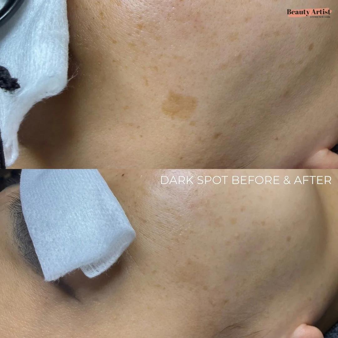 A closer look at visible discoloration ✨⁠
⁠
Dark spots and uneven-looking pigmentation can vary from person to person &mdash; including how they appear, their depth, and the approach that may be appropriate for each individual.⁠
⁠
That&rsquo;s why a 