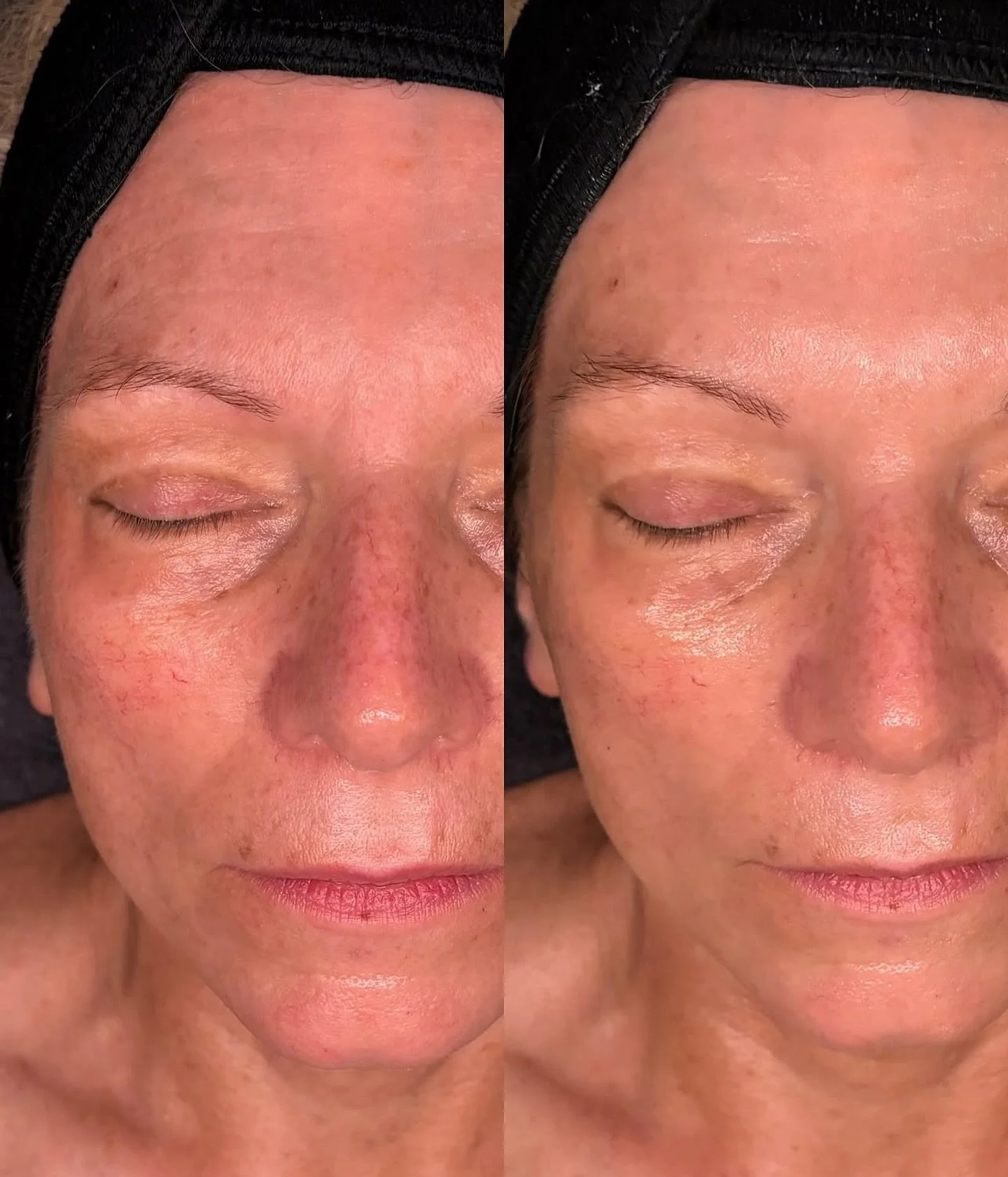 Results don’t lie. Book your facial today and see what the girls rave about. 
@esthetics.by.khloe