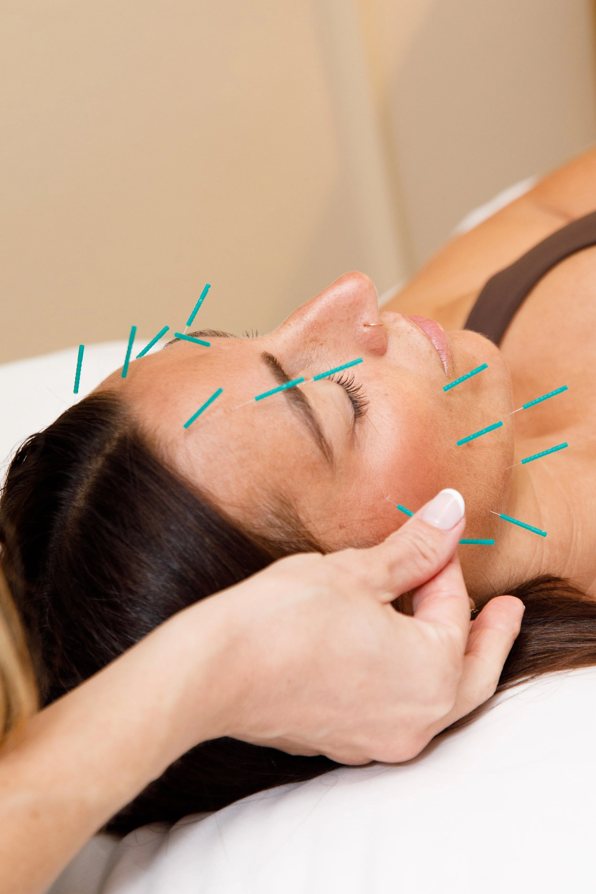 cosmetic acupuncture san diego