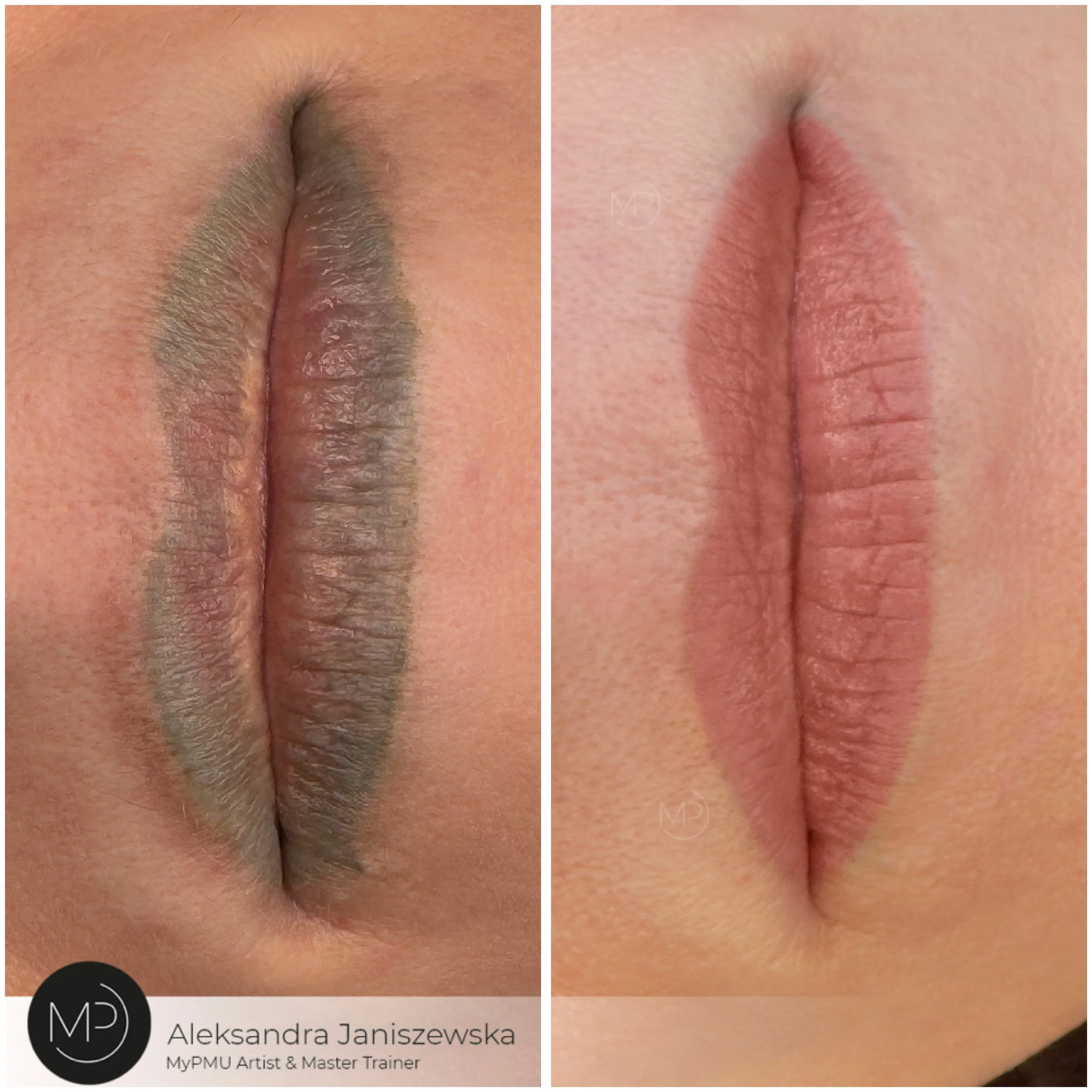 Lippenkorrektur – Beispiel 1