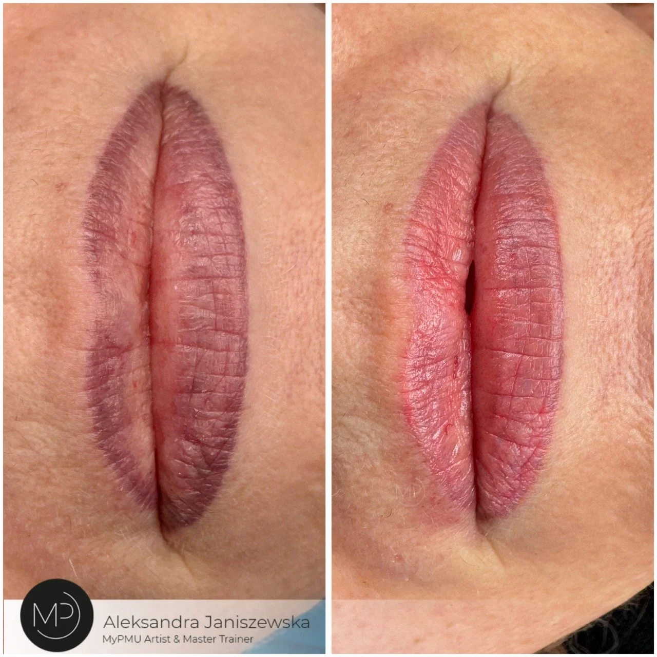 Lippen-PMU Korrektur Vorher–Nachher