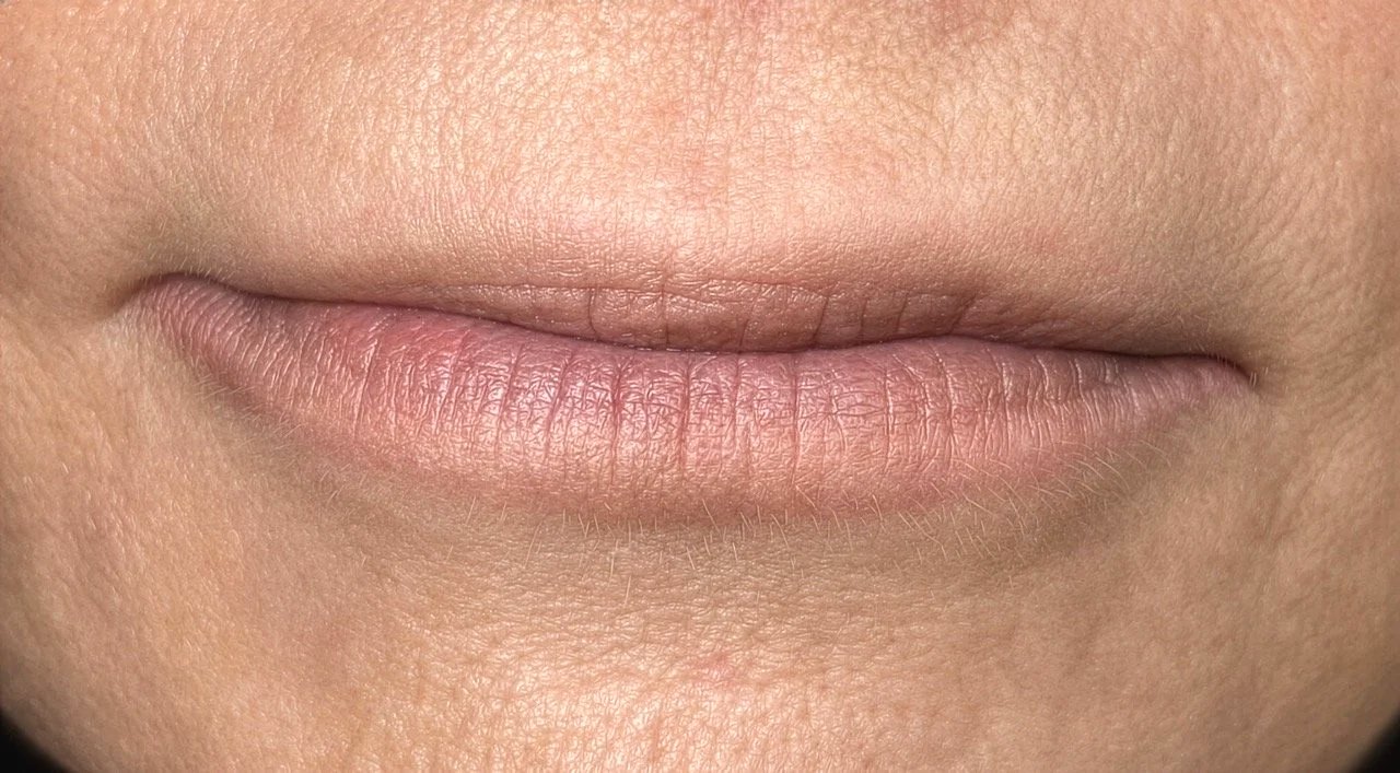 Aufhellung einer fehlerhaften Lippenpigmentierung mit Permanent Make-up Remover Abgeheilt 