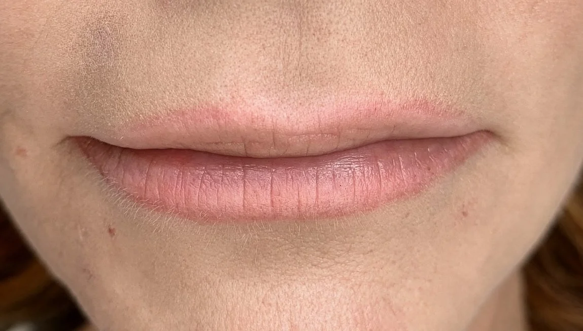 Aufhellung einer fehlerhaften Lippenpigmentierung mit Permanent Make-up Remover Nach 2 Behandlungen
