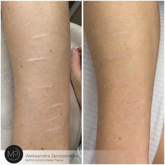 narben auf arm wien Średni.jpeg