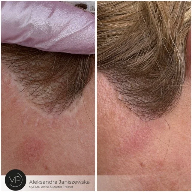 blizna po liftingu twarzy Średni.jpeg