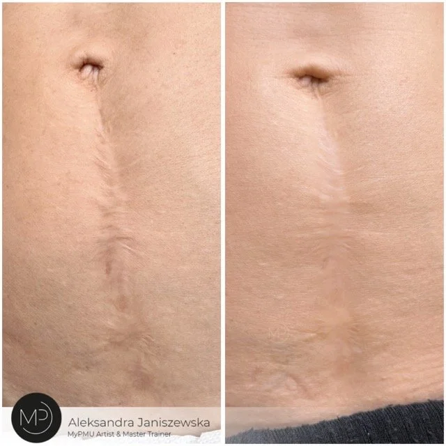 bauchnarben korrektur wien Średni.jpeg