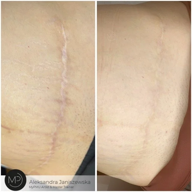 bauch narben korrektur wien Średni.jpeg