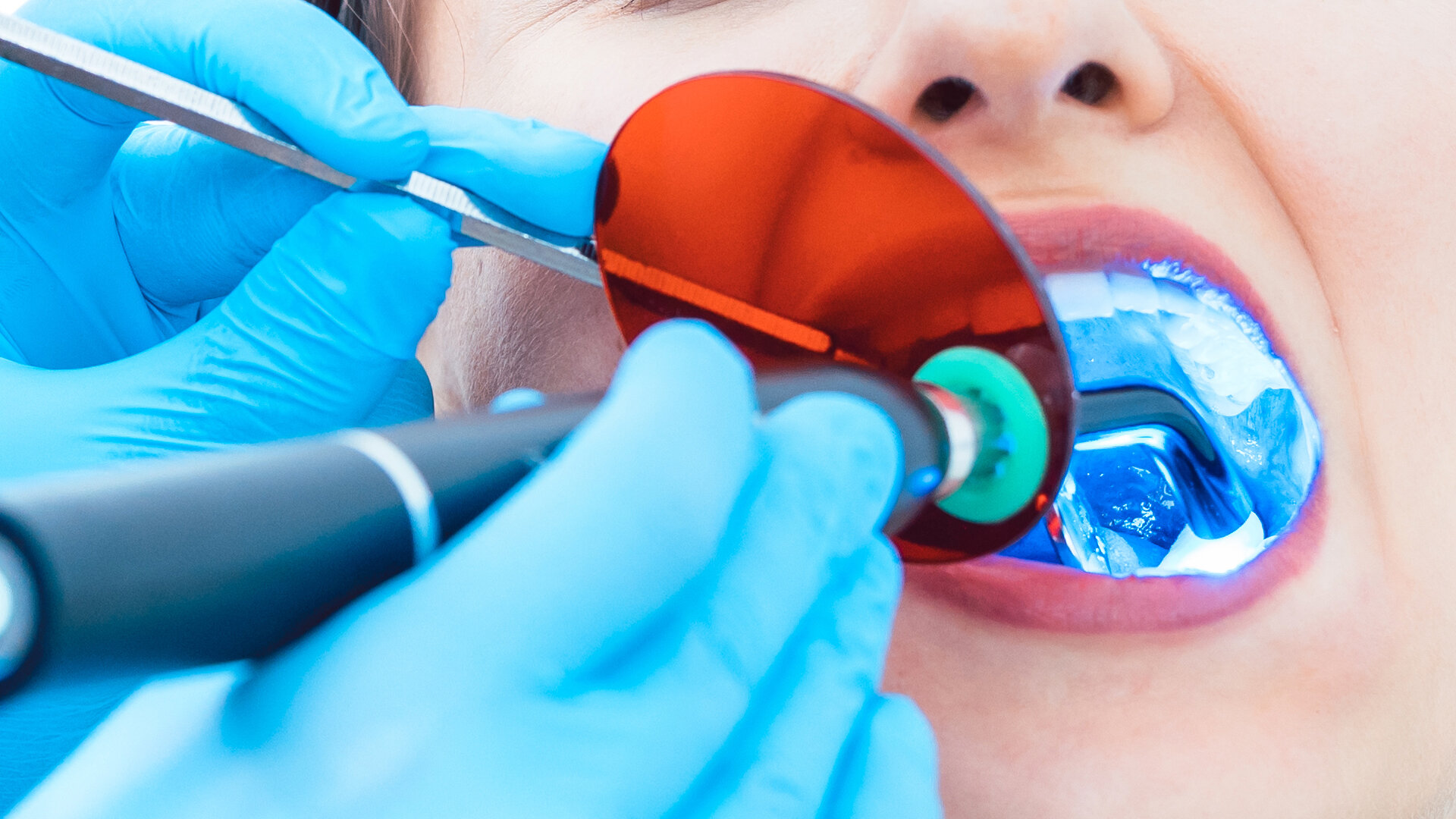 9 Ways Your Dental Curing Light Could Be Putting Composite Risk