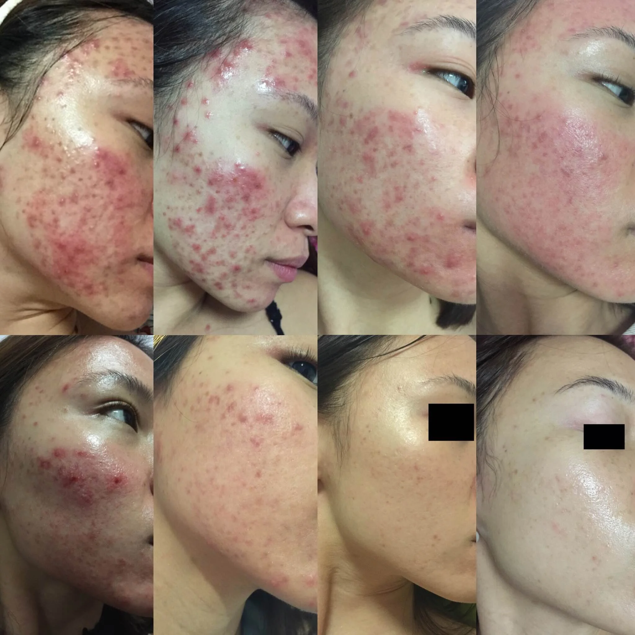 MY BATTLE WITH ACNE. YOU NEED TO READ THIS. (PART III)