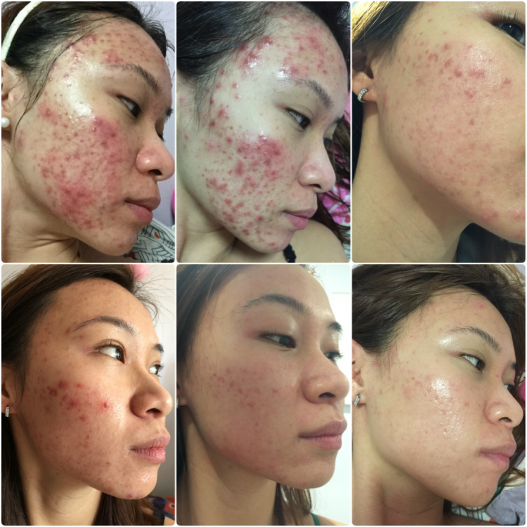 MY BATTLE WITH ACNE. YOU NEED TO READ THIS. (PART II)