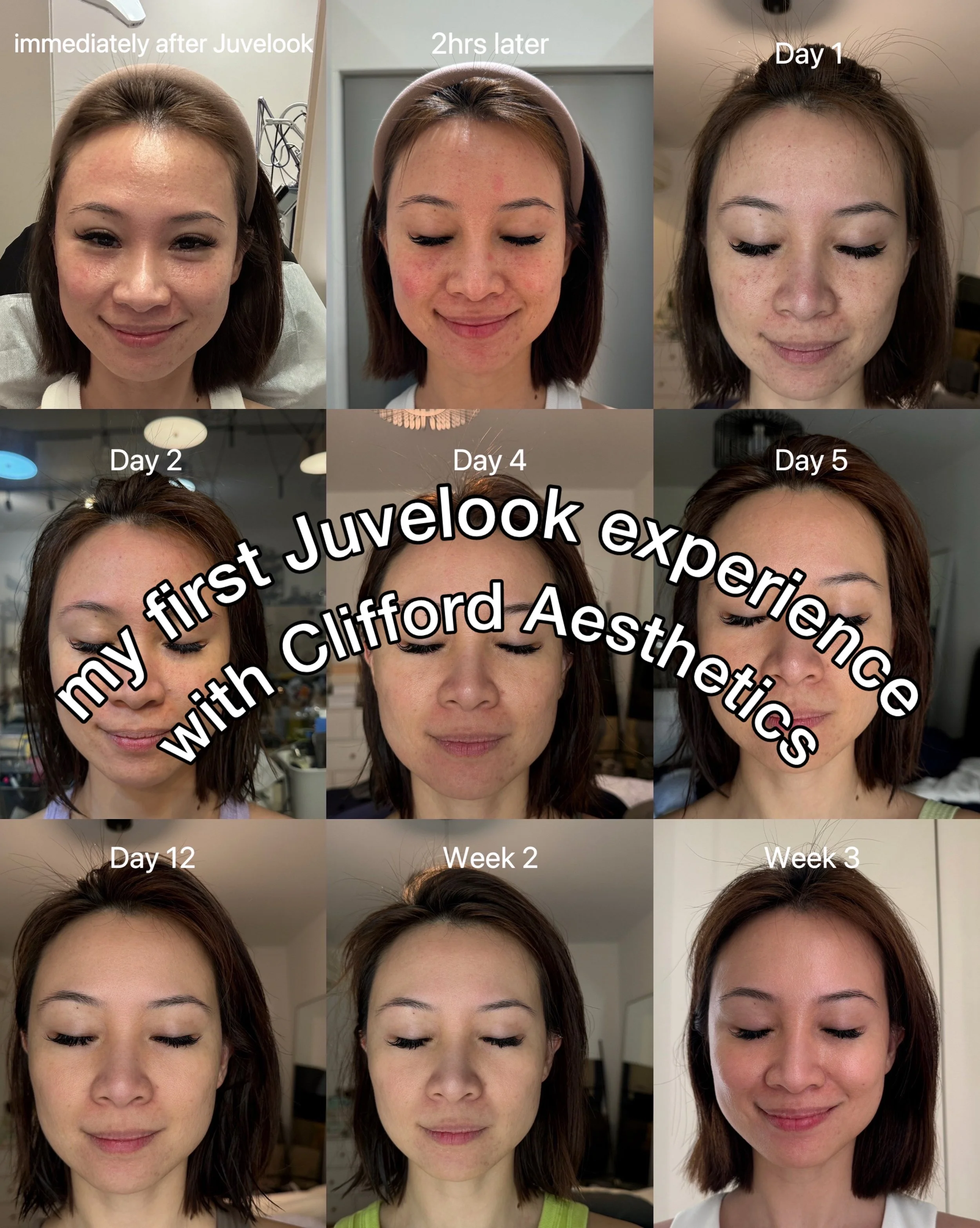 My Juvelook Collagen Skin Booster Experience with Clifford Aesthetics: A Journey to Anti-Aging &amp; Radiant Skin