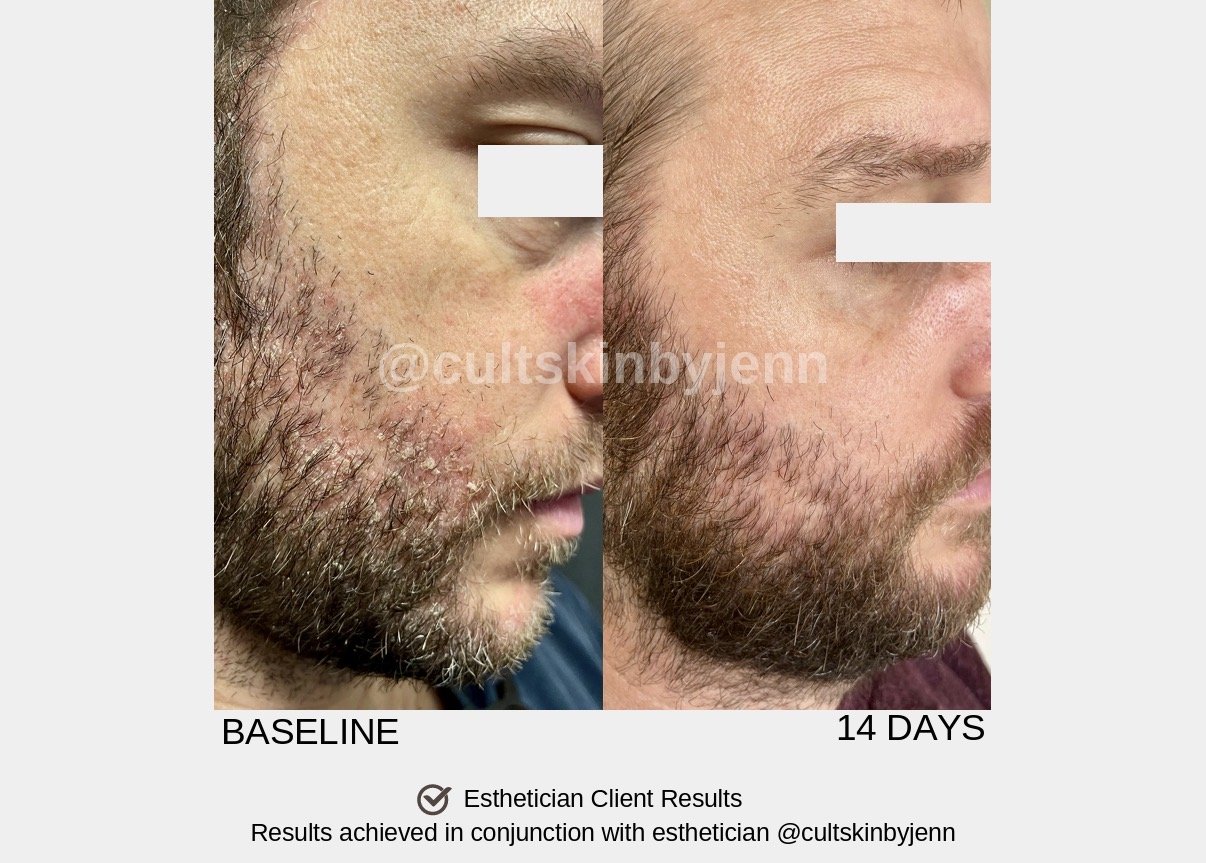 Comparison photo showing a man's beard area before and after 14 days of treatment. The left side labeled 'BASELINE' shows a patchy, sparse beard with uneven growth. The right side labeled '14 DAYS' shows significantly thicker and more uniform beard growth. Text indicates these are esthetician-client results achieved in conjunction with an esthetician.